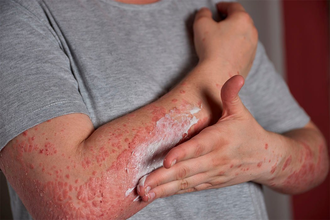 Herpes zóster